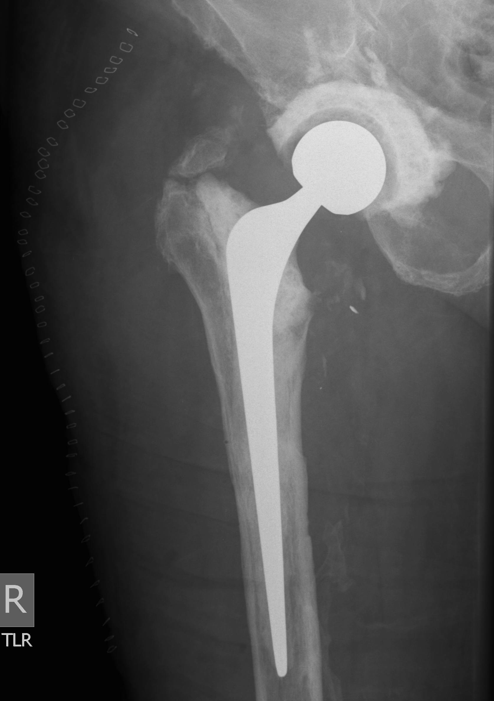 Infected THR Kiwi Hip Spacer